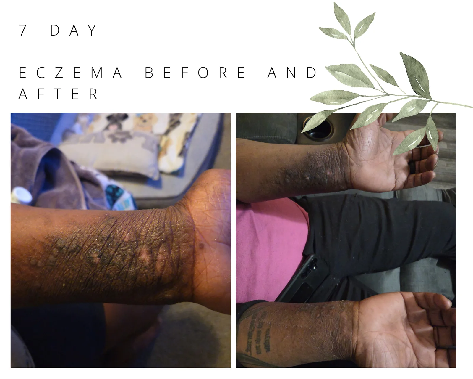 7-Day Eczema Relief