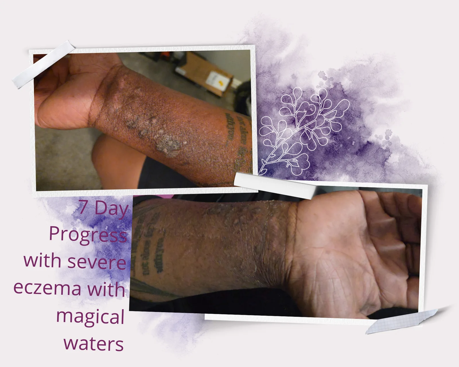 Severe Eczema · 7 Days
